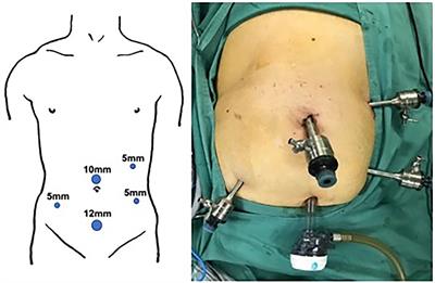 Priority Management of Henle Trunk in Cranial-to-Caudal Approach for Laparoscopic Right Hemicolon Cancer Surgery